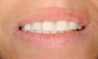 implante dentário