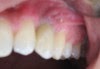 falta de um dente