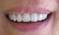 implantes
