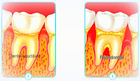 Periodontite - Implantes dentários