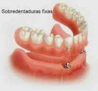 Sobredentadura